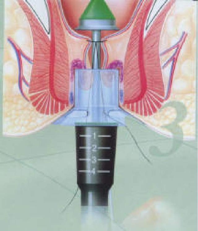 还在为痔疮、前列腺炎苦恼？提肛运动，一项受益终生的小举动 鹿血片 第3张