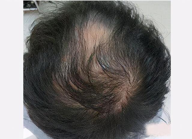 “桂枝龙骨牡蛎汤”治阳痿1例，李某36岁，腰酸脱发，全身怕冷 鹿血片 第1张