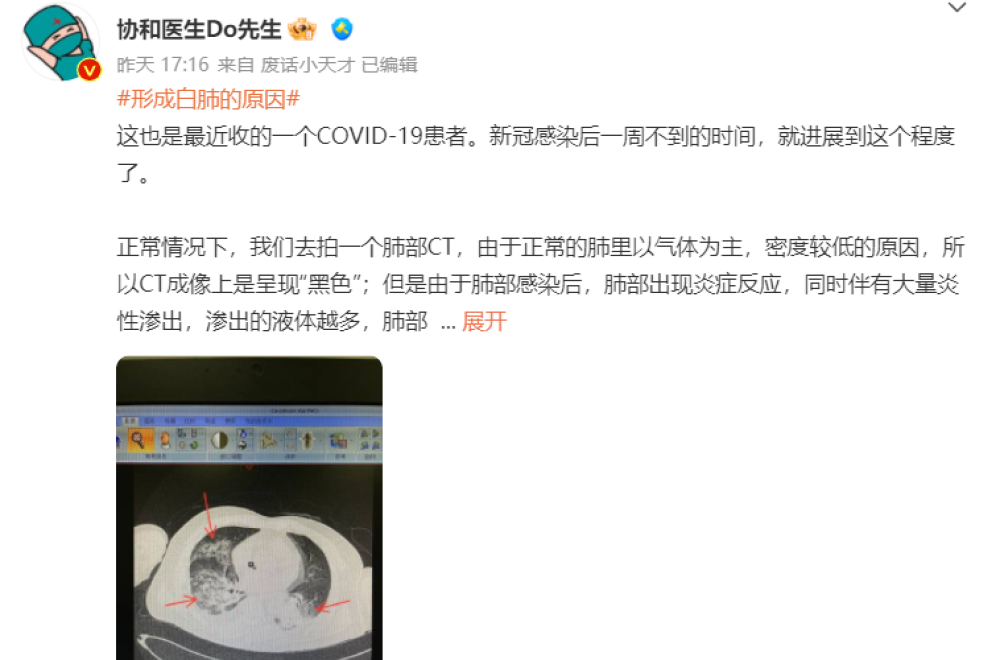“阳康”并非是痊愈的开始，医生提醒，出现这类症状请及时CT检查 鹿血片 第4张