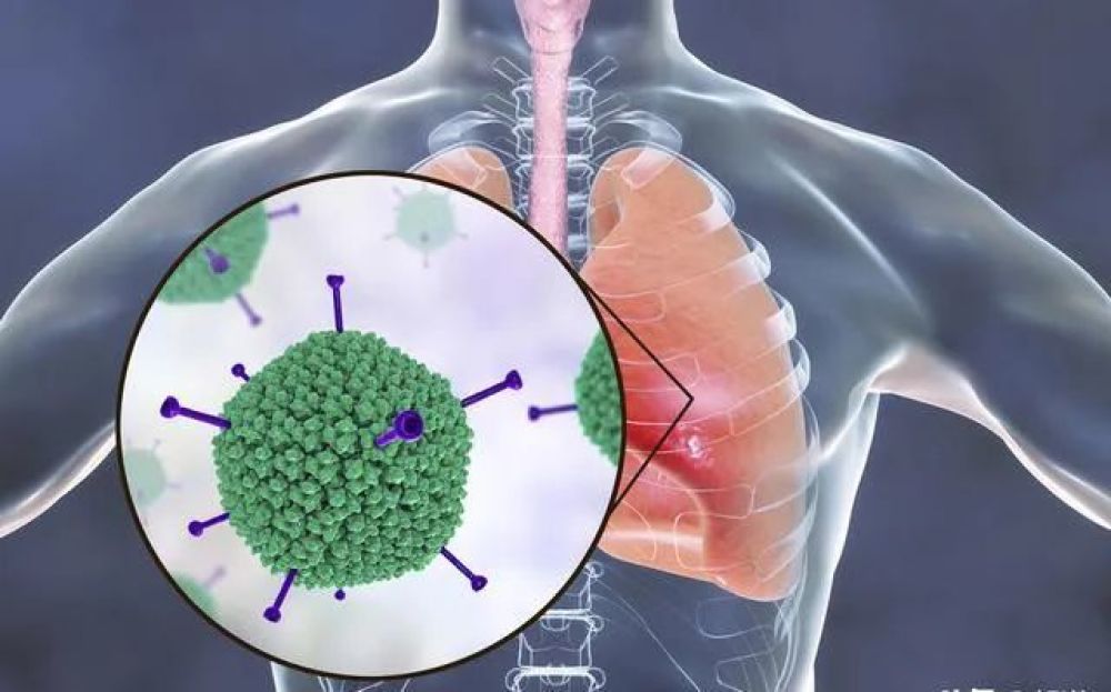 “阳康”并非是痊愈的开始，医生提醒，出现这类症状请及时CT检查 鹿血片 第5张
